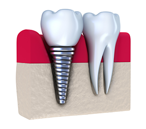 Dentist In Durham, NC Dental Implants| Thomas Clifton, DDS